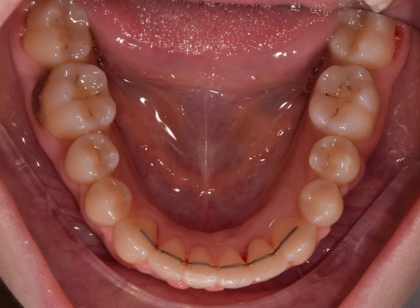 Fix retainer és MRI – kisebb kockázat, de nem elhanyagolható