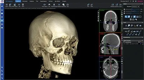 Háromdimenziós CBCT felvétel – fogszabályozási fogalom illusztrációja