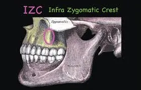 Crista infrazygomatica – fogszabályozási fogalom illusztrációja