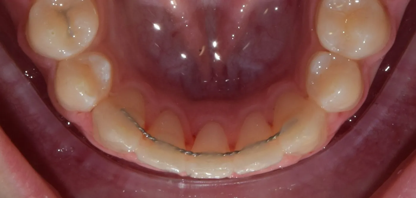 Fix retainer – fogszabályozási fogalom illusztrációja