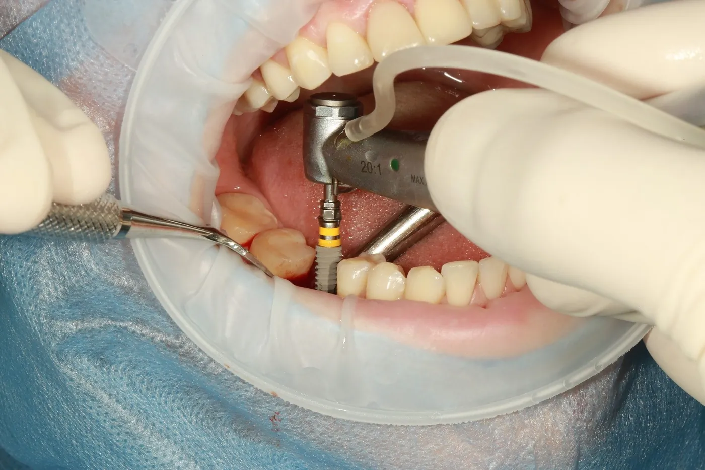 Fogászati implantátum – fogszabályozási fogalom illusztrációja