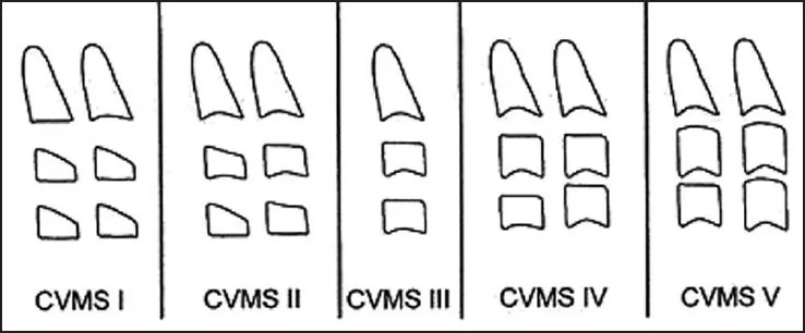 Nyakcsigolya érettségi besorolás (CVMS – Cervical Vertebral Maturation Staging) – fogszabályozási fogalom illusztrációja