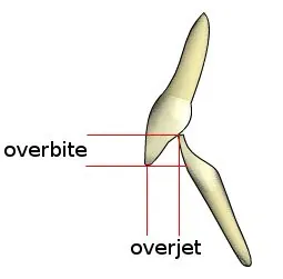 Overbite – fogszabályozási fogalom illusztrációja